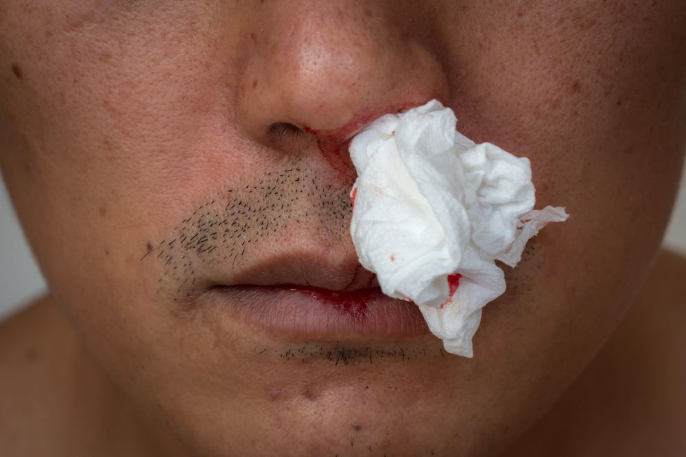 Připadá vám krvácení z nosu sexy?